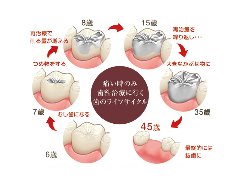歯のライフサイクル
